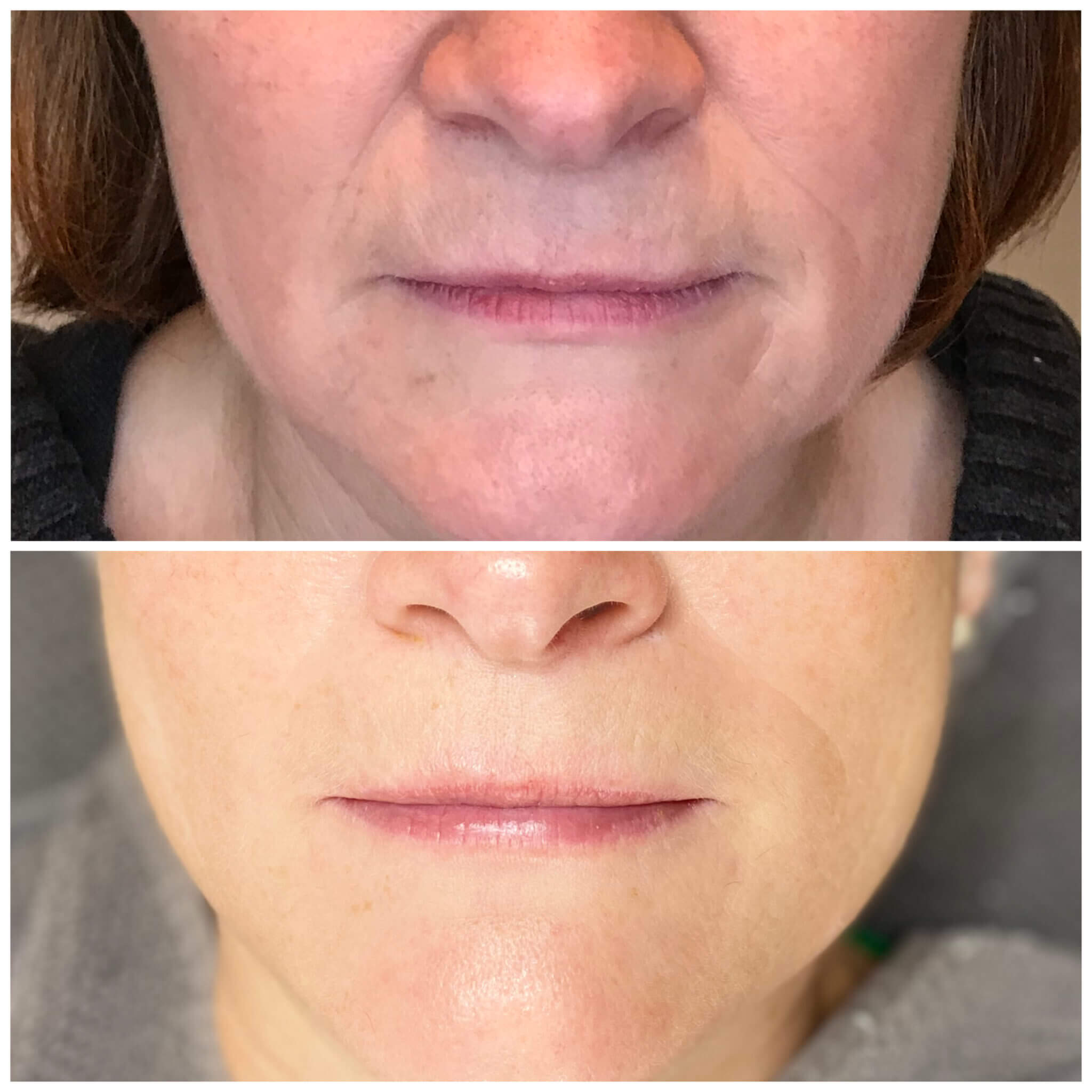 Vorher-Nachher-Vergleich der Stirn nach einer Anti-Aging-Behandlung