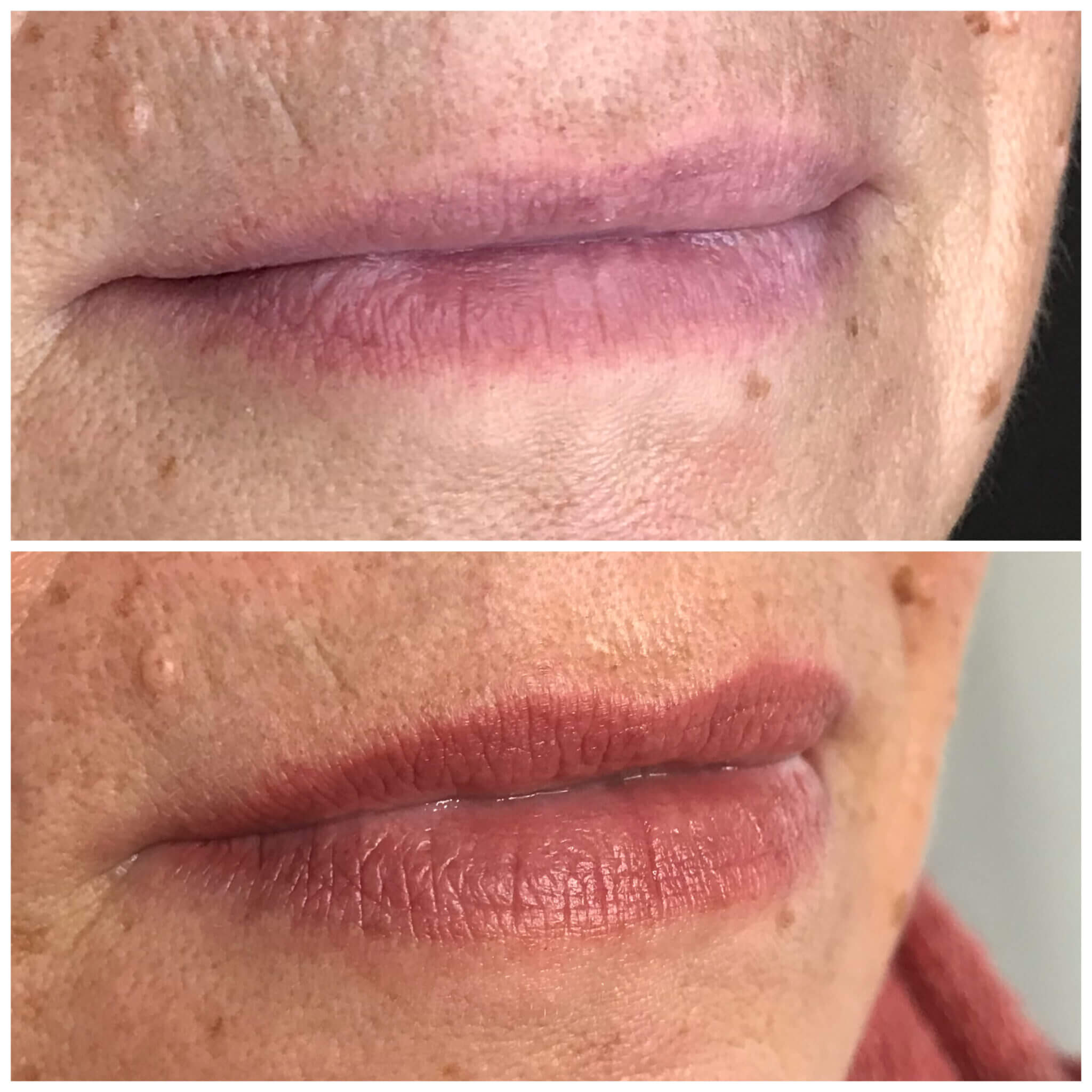 Vorher-Nachher-Vergleich einer Lippenpigmentierung für eine definierte Kontur