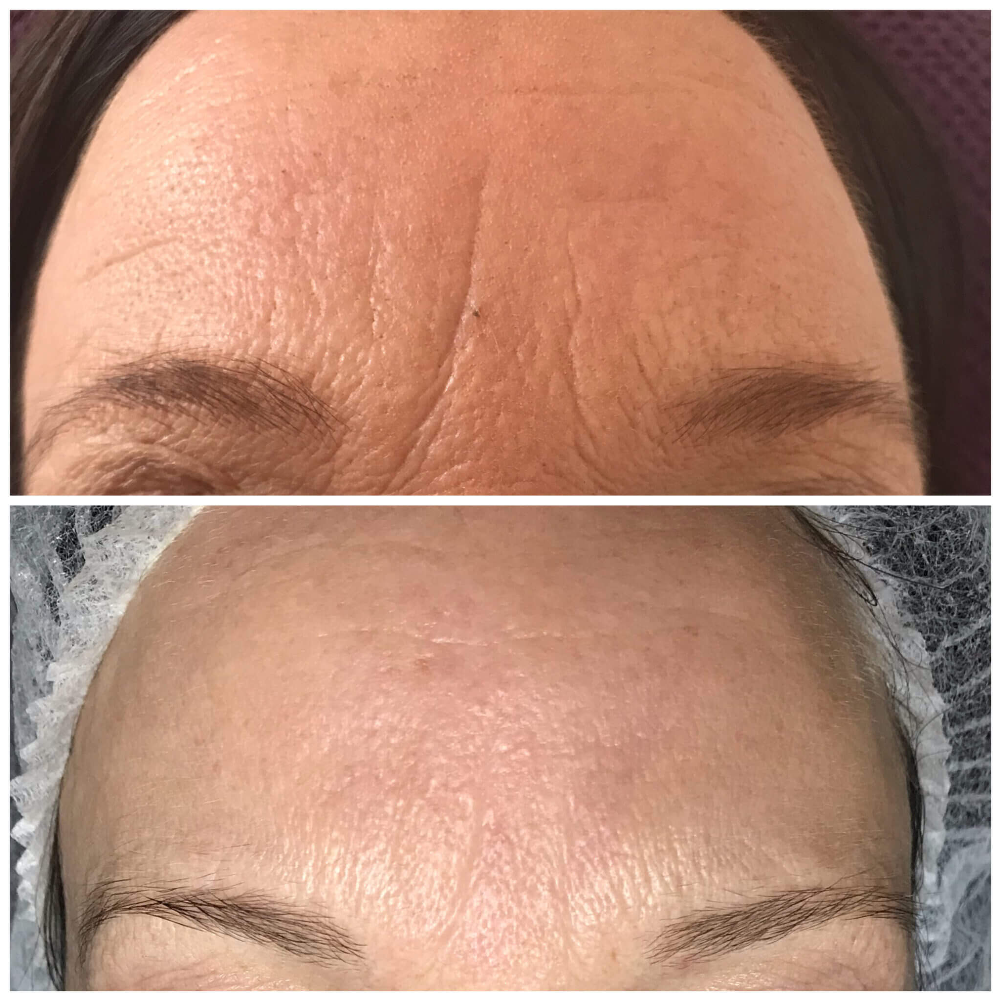 Vorher-Nachher-Vergleich der Stirn nach einer Anti-Aging-Behandlung